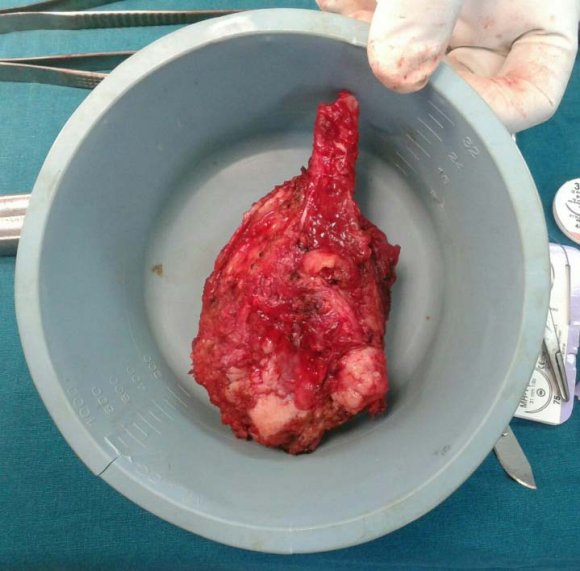 Figure 6: Showing en block resection