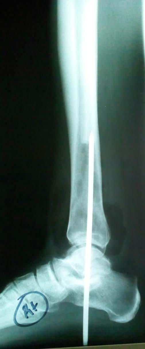 Figure 8: AP ankle day 1 post-op