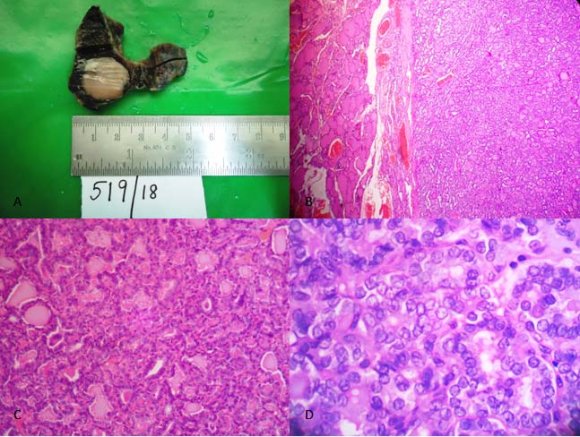 Non Invasive Follicular Thyroid Neoplasm with Papillary Like Nuclear Features (NIFTP): A Case Report