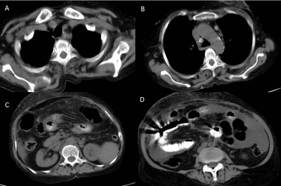 Figure 1: HRCT of thorax showing patchy areas of alveolar consolidation in the right middle lobe, in lingula (A) and multiple small nodular lesions in the peribronchial region in the anterior basal segment of the right lower lobe.(B)