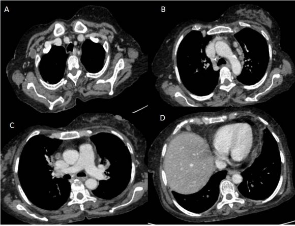 Figure 3: Contrast-enhanced CT scan of thorax showing lymph nodes in right axilla (A), in prevascular space (B,C), and the right juxtadiaphragmatic region (D) showing peripheral enhancement with central hypodense areas of necrosis.