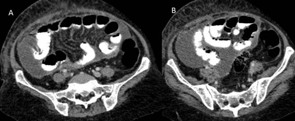 Figure 7: Contrast-enhanced CT scan of the abdomen showing thrombosis in the right common iliac vein (A, B)