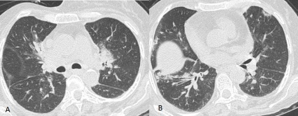 Dr. Sanjay M. Khaladkar ? , Dr. Amit A. Choure ? & Dr. Suhani Jain ? Volume XIX Issue II Version I Abdominal Ganglionic Tuberculosis with Inferior Vena Cava and Common Iliac Vein Thrombosis-A Case Report nucleated cells was 800 cells/mm 3 , which were predominantly lymphocytes. The patient put on Antituberculous treatment. After two months of follow up, the patient showed symptomatic improvement.