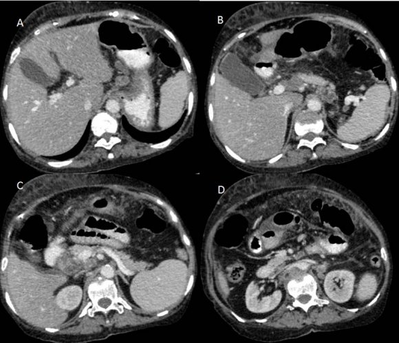 Figure 4: Contrast-enhanced CT scan of the abdomen showing lymph nodes at the celiac axis (A, B), in precaval region (C), in the left para-aortic and preaortic region (D) showing peripheral enhancement with central hypodense areas of necrosis.