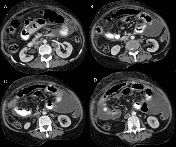 Figure 5: Contrast-enhanced CT scan of the abdomen showing lymph nodes at left para-aortic and inter-aortocaval region (A, B), a filling defect in IVC suggestive of IVC thrombosis (C, D).
