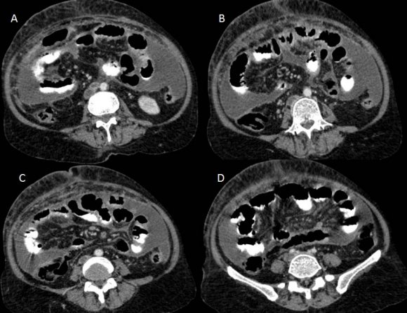 Figure 6: Contrast-enhanced CT scan of the abdomen showing lymph nodes in precaval region (A) with thrombosis in IVC (A-C) extending right common iliac vein (D)