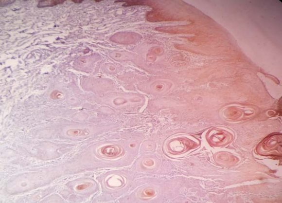 Figure 4 : a) renal biopsy staining with Congo red stain b) apple green birefringence under polarized light