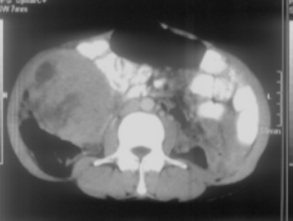Fig C and D : Pre chemotherapy CT scan showing recurrent mass in mesentery and huge pelvic mass.