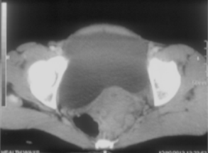Fig E and F : CT scan done after 6 cycles for interval assessment showing regression of masses.