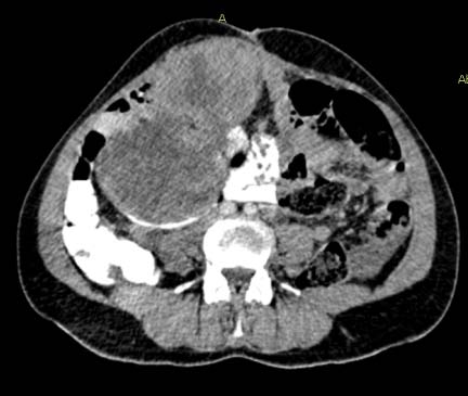 Fig G and H : CT scan done after completion of chemotherapy showing resolution of mesenteric mass and further regression of pelvic mass