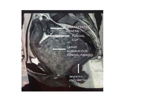Figure 2 : In-situ findings during laparotomy showing inverted fundal cup caused by the prolapsed submucosal fundal fibroid with consequent incarceration of the adnexal structures within it. Also the anatomy is grossly distorted.