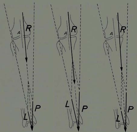 Fig (c).Moved in; load R causes stress concentration compression joint are greatly increased in that the medial knee ( fig.18)