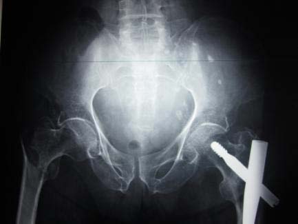 Figure 5 : The right trochanter contralateral communitive fracture