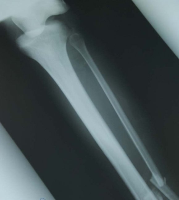 Figure 3 : Anterio-posterior radiography of the knees