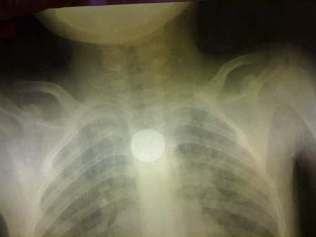 JournalsA front and side cervical x-ray is taken to visualize the EC. The children were explored by a rigid endoscope under halogenated anesthesia and sedation by propofol in spontaneous ventilation and without trachéal intubation