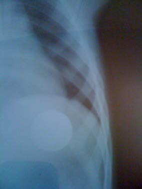 Fig. 1: Graphical breakdown representing the workforce by age expressed by age class in months The average time for taking charge is 19.14 ± 0.729 hours; the children are oriented from different wilayas of central and western Algeria. All the children had no particular antecedents except two ashtmatic under treatment.Ingestion was asymptomatic in 30 cases. It was followed by a hyper sialorrhea in 01 cases, a swallowing gene with vomiting in 2 cases and dysphagia in 2 cases.