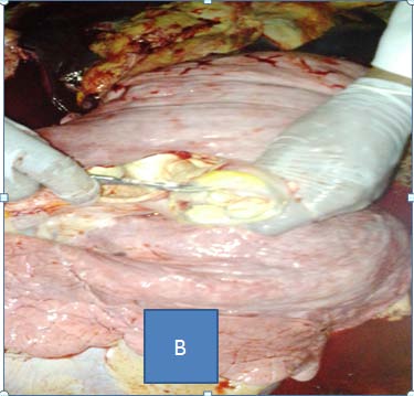 Figure 3 : Electrophoretic separation of PCR products by RD9 deletion typing of 11 mycobacteria isolates from human TB patients. 15-ladder (100bp), 14-Mycobacterium tuberculosis control, 13-distilled water negative control, 12-Mycobacterium bovis control and 1 to 11 are samples from TB patients.