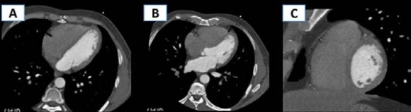 Computed Tomography in the Assessment of Cardiac Adipose Tissue and Coronary Artery Atherosclerosis