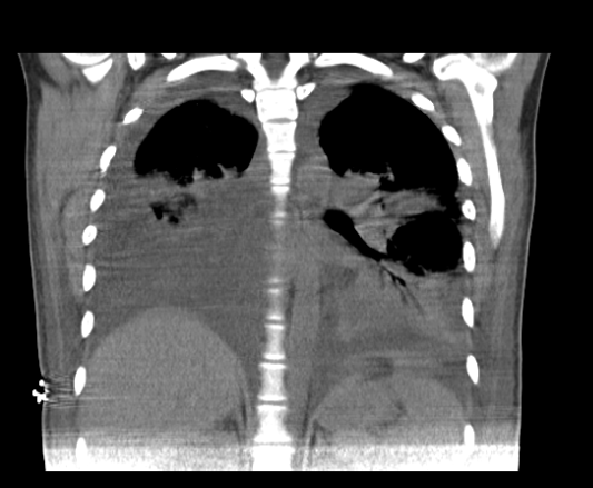 Figure 2: Chest tomography, coronal section. Bilateral pleural effusion. Source: authors.