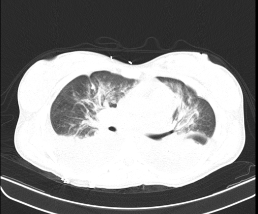 Figure 3: Chest tomography, axial slice. Bilateral pleural effusion. Source: authors. III.