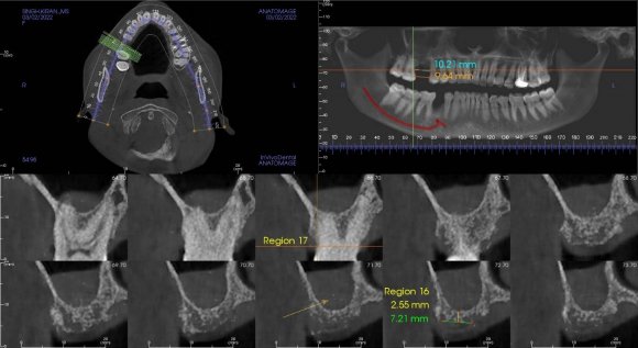membrane and place graft for augmentation using high hydraulic pressure: 18-month follow-up of 20 cases. Oral surgery, oral medicine, oral pathology, and oral radiology. 2013; 116(3): 293-300. DOI: 10.1016/j.oooo.2013.05.014.