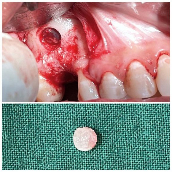 Figure 1: CBCT revealing the readings for the edentulous site