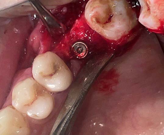 Figure 4: Soft tissue closure obtained