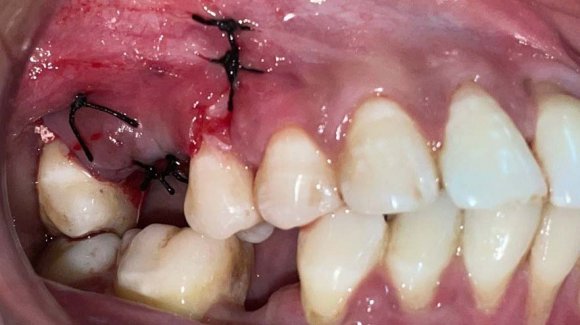 Figure 10: Crestal Approach Sinus Lift Kit