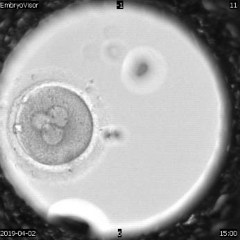 Figure 2: Human embryo of the 1st day of development at the 3PN2PB stage, magnification 200X.