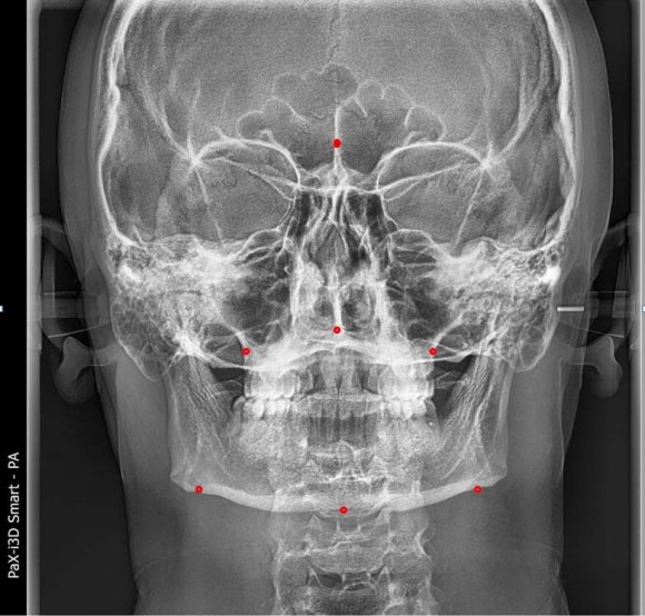 connecting the middle point of the maxillary growth -midsagittal line bn 4 Cg-J Crista galli -Jugal Process plane) frontal growth of the nose-cock (the line connecting the point of the crown (Cg) with the growth of the upper jaw 5 Ag-Ag Antegonial notch plane-Antegonial notch plane the middle point of the groove of the angle of the lower jaw is the line connecting the right and left sides 6 Cg-Ag Crista galli -Antegonial notch plane) -the forehead growth of the nose -the line connecting the point of the crown of the cock (Cg) with the point of the angle of the lower jaw ( 7 Ag-MSR Antegonial notch-Mid-sagittal reference plane Distance from the groove of the angle of the mandibular joint to the midsagittal line In this study, we determined and tabulated the indicators of "maxilla-mandibular relationship" according to Grummons' frontal cephalometric analysis in representatives of the Uzbek population with normal physiological pricus (table3).