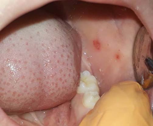 The percentage refers to the proportion of the total number of patients in each group with some alteration. Groups: Healthy (healthy children), T1DM (Type 1 Diabetes Mellitus), B-cell ALL (B-cell Acute Lymphoblastic Leukemia). *p-value confirmed by Pearson's ? 2 method for proportions; a p-value less than 0.01 is considered significant. Study groups: healthy (healthy) children, children with Type 1 Diabetes Mellitus (T1DM) or B-cell Acute Lymphoblastic Leukemia (B-cell ALL). Year 2022