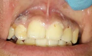Presence of anemia in distinct groups of patients* Type 1 Diabetes Mellitus), B-cell ALL (B-cell Acute Lymphoblastic Leukemia).