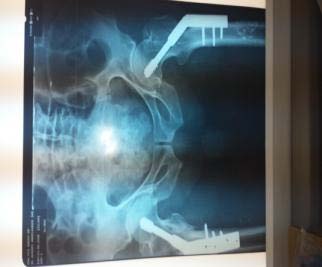 Figure 4 : Undisplaced contralateral fracture