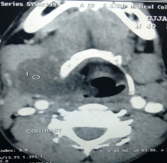 Figure 2a : Human dental arch.Figure 2b : Change of parabola to ellipse at canine.