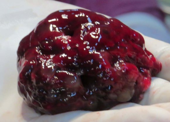 Figure 3 : Presence of cavernous spaces containing blood elements lined by flattened endothelium.(10X)