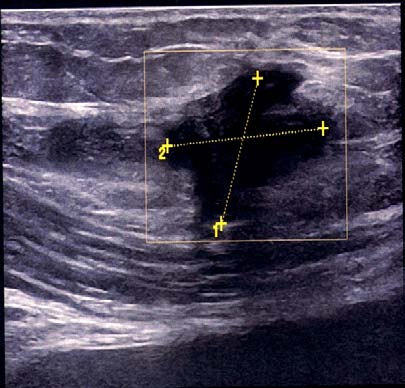 Figure 1 : échographie +doppler de la paroi abdominale montrant le nodule endométriosique