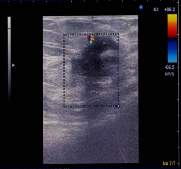 Figure 3 : a) coupe coronale, b) coupe transversale : images IRM montrant l'implant endométriosique infiltrant l'aponévrose des muscles grand droit IV. Commentaire L'endométriose est une pathologie non néoplasique quasi exclusive de la femme en période d'activité génitale qui se définit par la présence du tissu endométrial en dehors de la cavité utérine, l'endométriome est une forme de l'endométriose sous forme d'une masse solide ou kystique, les endométriomes pariétaux sont rares, observés surtout sur cicatrice chirurgicale dans notre étude 6 patientes avaient un antécédent de césarienne avec cicatrice pfannentiel
