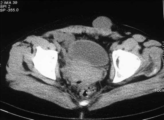 Figure 4 : aspect macroscopique d'un nodule endométriosique de couleur jaune au sein du tissu musculaire