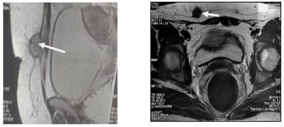 Figure 5 : Coupe histologique montrant les glandes endométriales dilatées