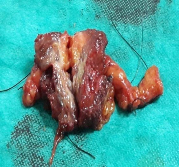 Lamblin G, Mathevet P, Buenerd A. Endométriose pariétale sur cicatrice abdominale, à propos de trois observations. J Gynecol Obstet Biol Reprod (Paris) 1999; 28: 271-4. 2. Hughes ML, Bartholomew D, Paluzzi M. Abdominal wall endometriosis after amniocentesis. A case report. J Reprod Med 1997; 42: 597-9. Volume XVI Issue I Version I © 2016 Global Journals Inc. (US)