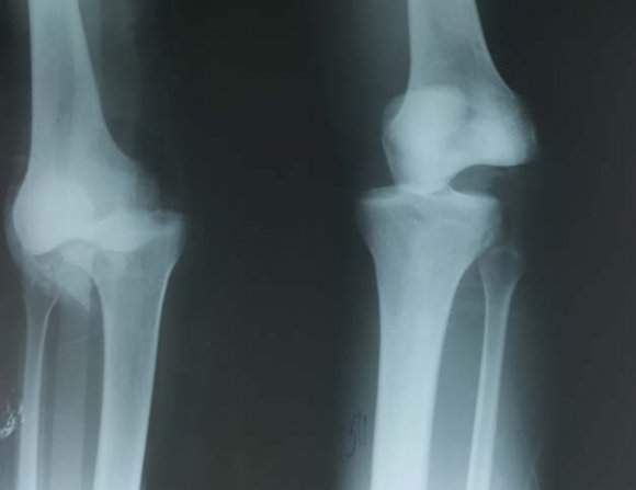 Figure 2 : Radiography showing tibial shaft with knee dislocation.