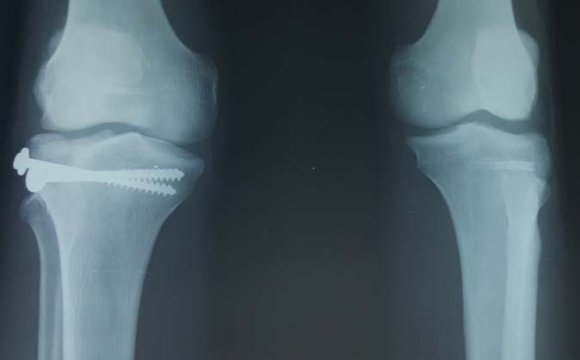 Figure 4 : latearl radiography of the knees