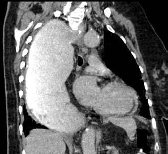 Figure 3 : Included and excluded patients.