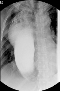 Figure 2 : Dilation of the gastic tube due to the volvulus.