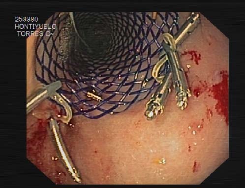 Figure 5 : The placement of the stent, both, endoscopist and interventional radiologist.