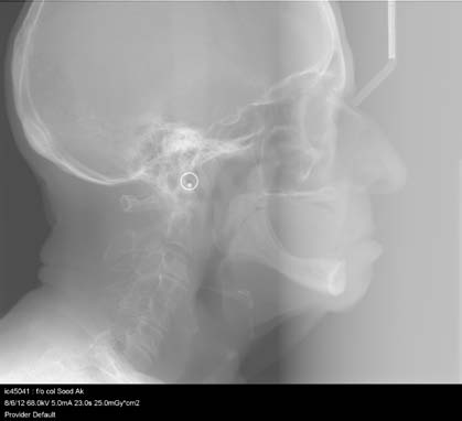 Figure 1 : Pre-insertion Cephalogram Figure 2 : Post-insertion Cephalogram