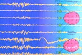 Brief Overview of Epilepsy e) Deep brain stimulation (DBS)