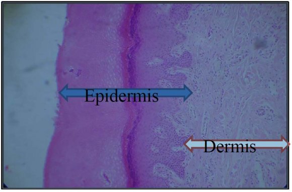 Figure 2 : Changes of protein C levels in patients with lower limb erysipelas Note: 1-8 with CVI, 9-36 without CVI, LL -lower limb