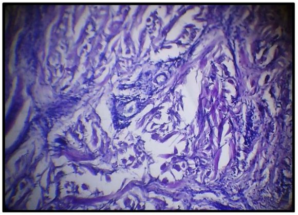 Figure 4 : Erythrocytes' deformability (LaCl3) and elasticity (PS) in aggregation tests in facial and lower limb erysipelas Note: d/d -days of the disease One has to note, that the erythrocytes play not only the role of oxygen transporter in the blood flow.They also serve as a potent buffer of the system of hemostasis and as a second, in order of importance (after albumin), detoxification barrier. The body uses the erythrocyte pool for supplementary refilling of protein deficit in the blood flow[7]. The discoid form allows the erythrocytes to perform their functions with maximal