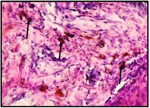 Laboratory studies confirmed that clinical hemorrhagic complications are by 3,9 times more limb erysipelas than in facial erysipelas. 2. The results of determination of the markers of hemostatic endothelial function in erysipelas patients suggest the disturbances of endotheliumrelated regulation of hemostasis, as judged by antithrombotic (decreased levels of protein C and of AT-III), as well as by adhesive indices (high level of von Willebrand factor). 3. Increased D-dimer and decreased alpha-2-